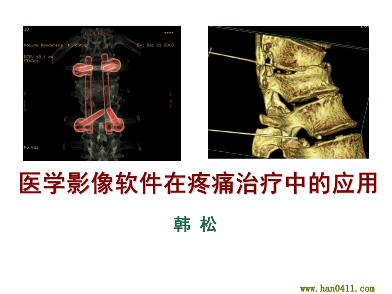 医学影像软件在疼痛治疗中的应用