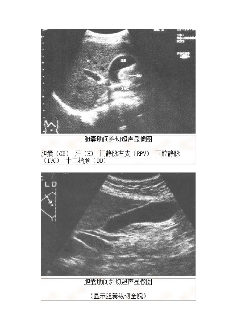 胆囊标准切面影像