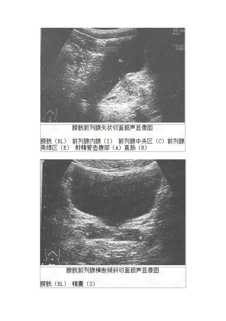 膀胱前列腺标准切面影像